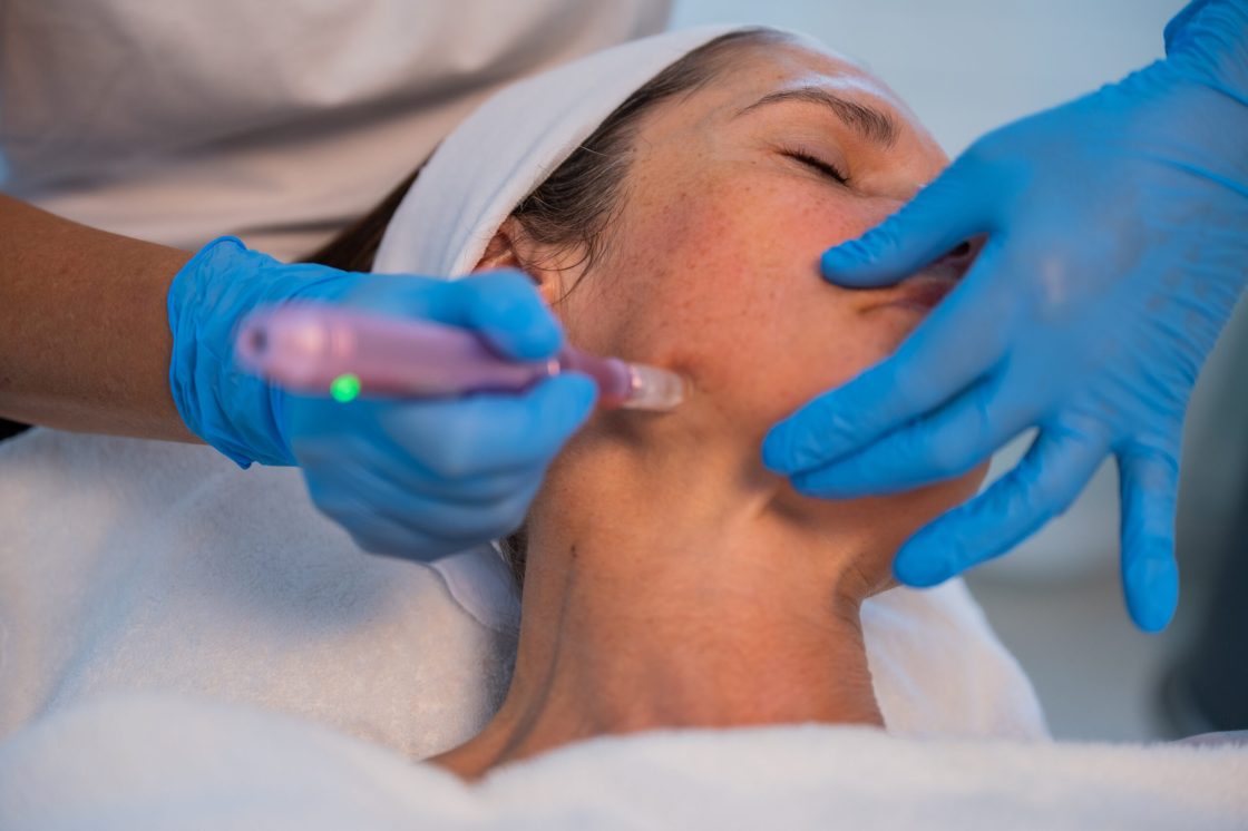 Microneedling_beaute-des-pres